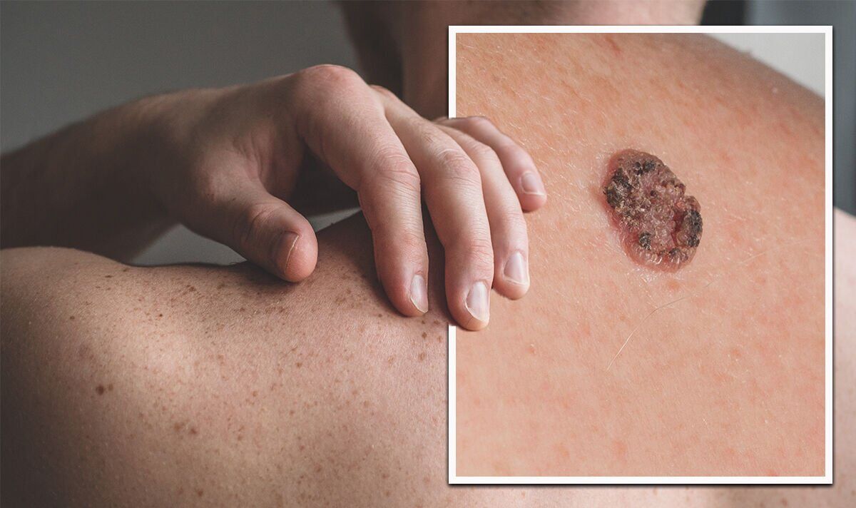 What Are the Main Signs of Skin Cancer